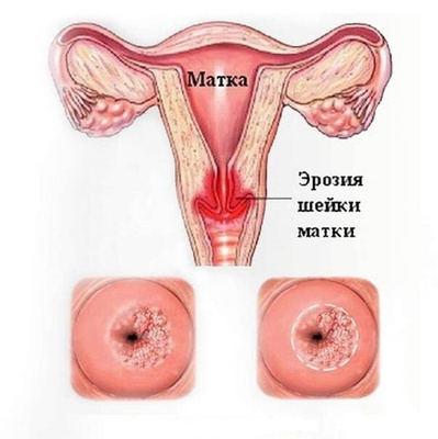 Как выглядит матка реальное фото