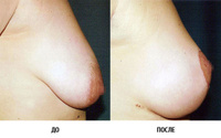 Коррекция опущения груди (вертикальная мастопексия)
