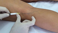 Склеротерапия безоперационное лечение вен сосудистых звездочек на ногах