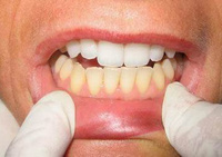 Лечение дисколорита зубов